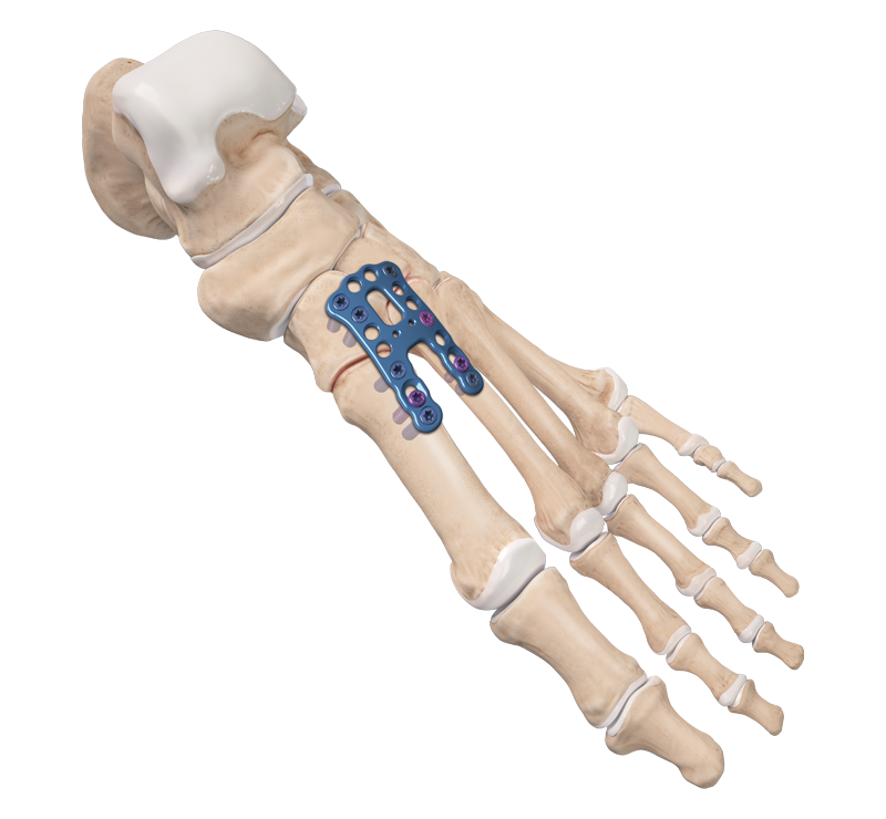Arthrex - Lisfranc Plate, Large, Right, Titanium - AR-8951LR